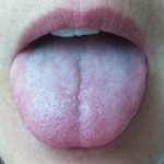 Witte tong behandelen 