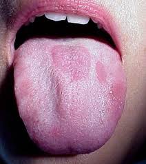 Vlekken of plekken op de tong